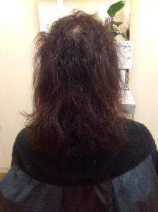 薬の副作用で髪質が変わってしまった方の1年後！