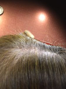 髪が少なくなってきたのが気になるなら、ホスピが絶対お勧め！