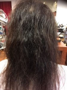 薬の副作用で髪質が変わってしまった方のさらに９か月後！